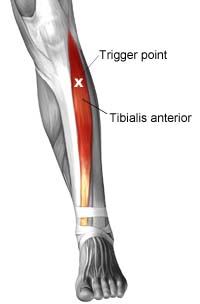 Massage for Shin Splints